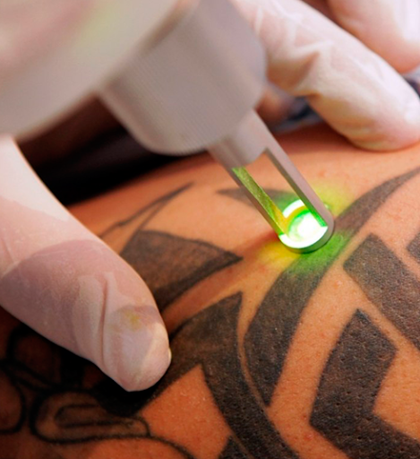 Лазерне видалення татуювань