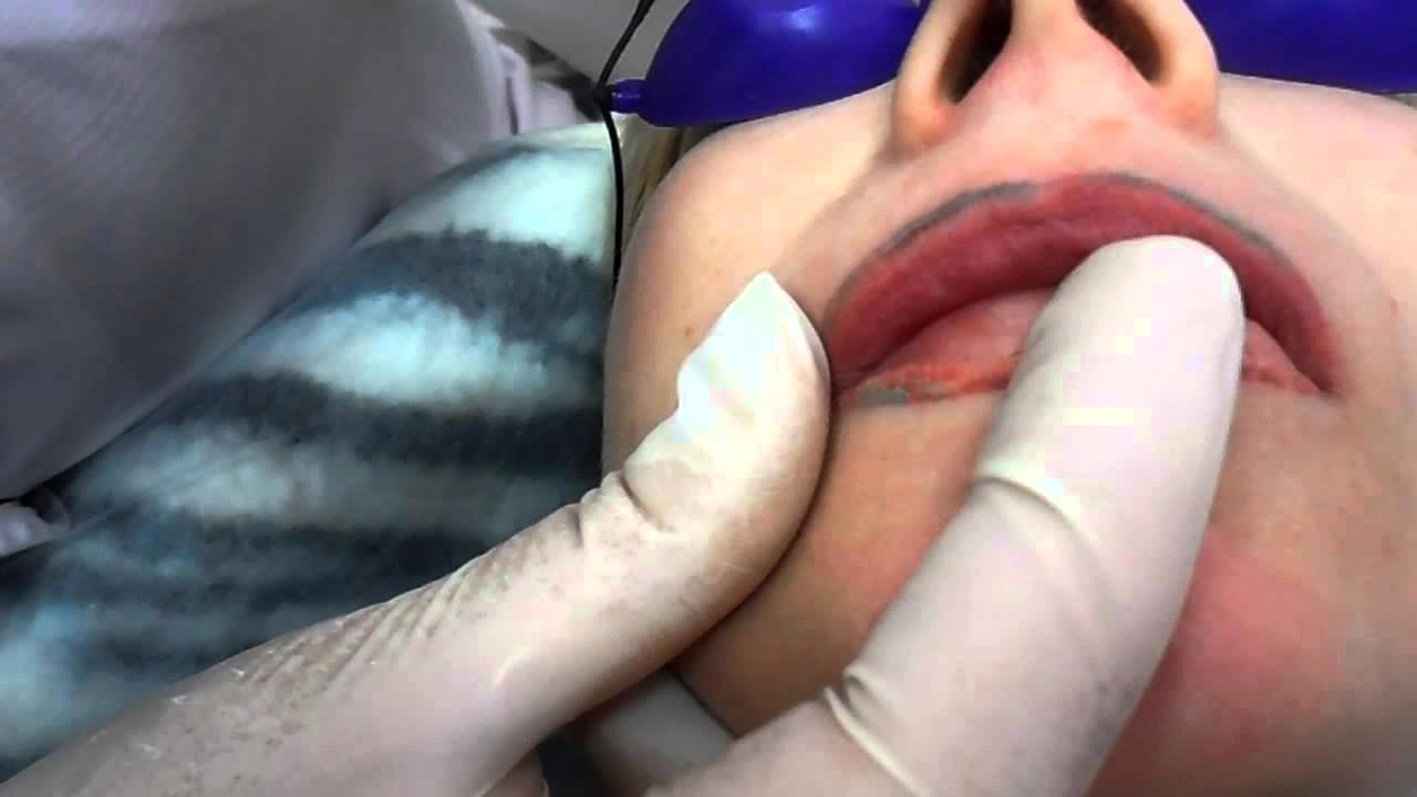 удаление татуажа губ
