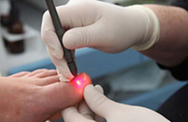 Лазерное лечение грибка ногтей в Киеве