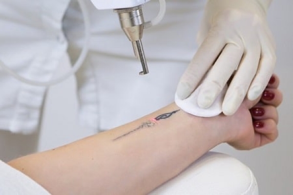 Лазерне видалення татуювань в Києві